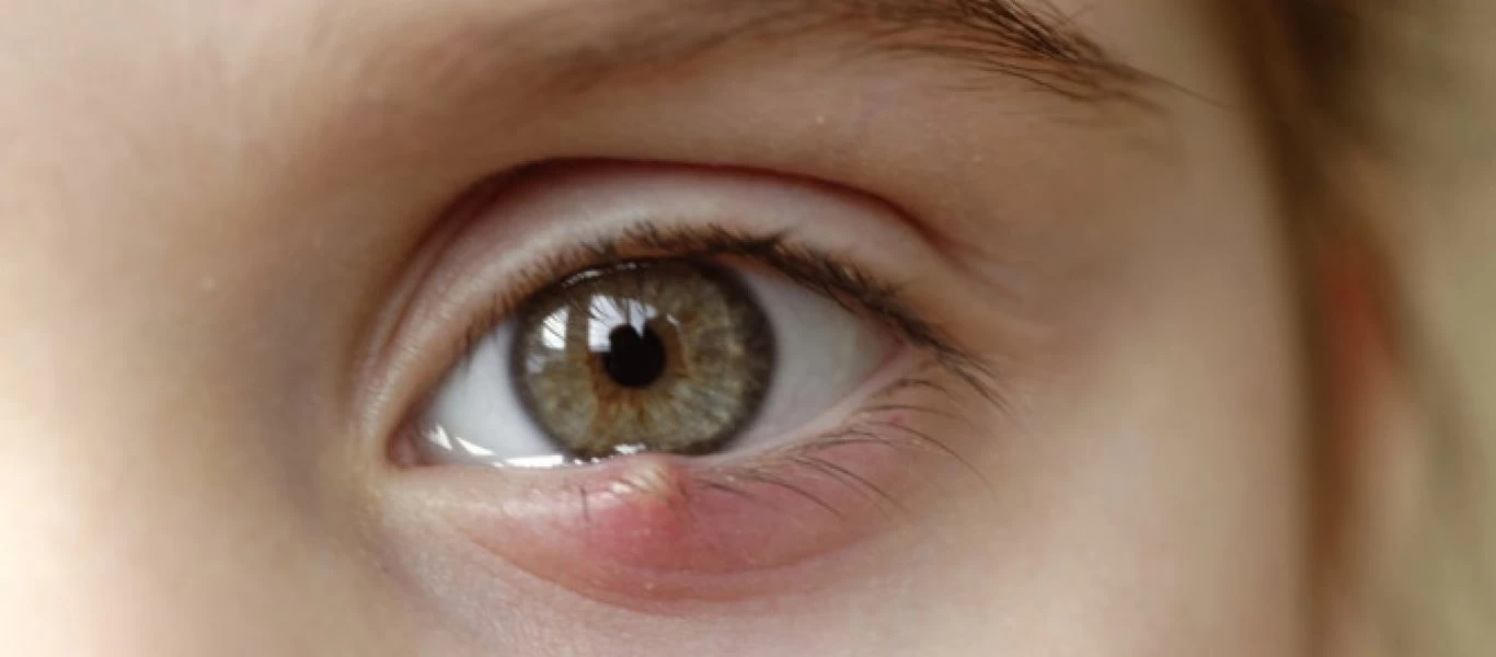 Κριθαράκι στα μάτια: Γιατί βγαίνει; - Τι πρέπει να κάνουμε;